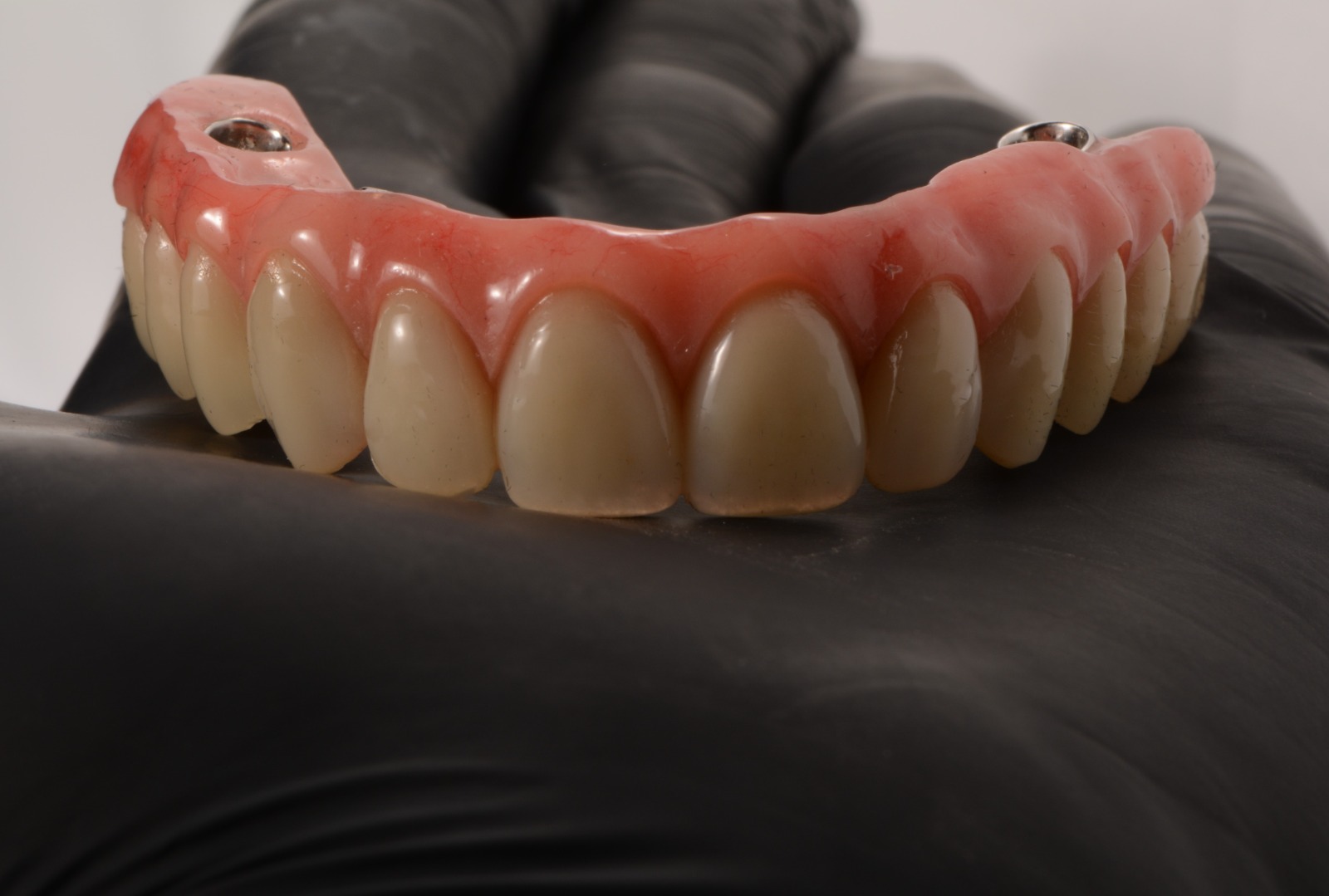 PERDI TODOS OS MEUS DENTES, CONSIGO USAR UMA PRÓTESE QUE SEJA FIXA?